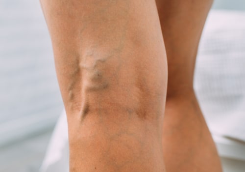The Power of Vitamin K2 in Treating Varicose Veins and Spider Veins